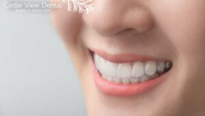 Invisalign Clear Braces - Cedar View Dental - Lynnwood, WA